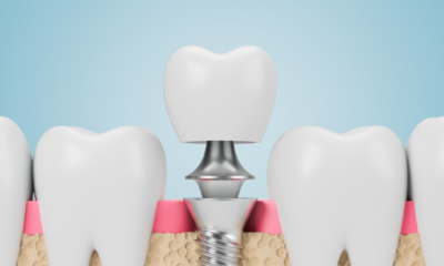 CNC Machining Tooth Implant