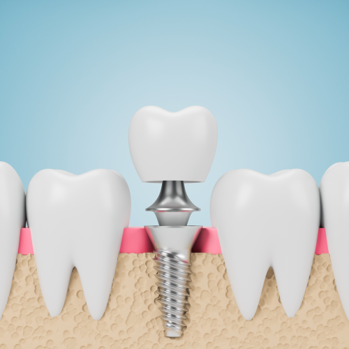 CNC Machining Tooth Implant